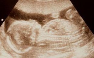 开封市妇产医院做三代试管成功率如何？一文读懂需要花多少钱